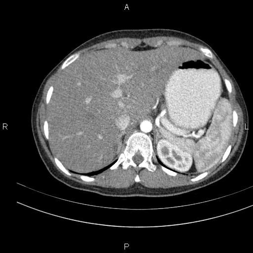 File:Chronic pancreatitis (Radiopaedia 64576-73450 B 24).jpg