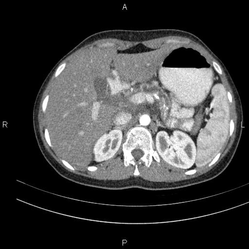 File:Chronic pancreatitis (Radiopaedia 64576-73450 B 36).jpg