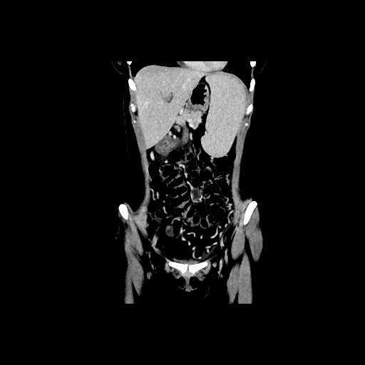 Chronic portal venous thrombosis with cavernous transformation (Radiopaedia 73618-84398 B 48).jpg
