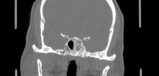 Chronic sphenoidal sinusitis (Radiopaedia 62030-70122 Coronal bone window 125).jpg