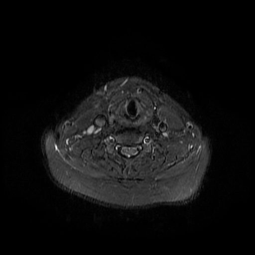 File:Chronic submandibular sialadenitis (Radiopaedia 61852-69885 Axial STIR 20).jpg