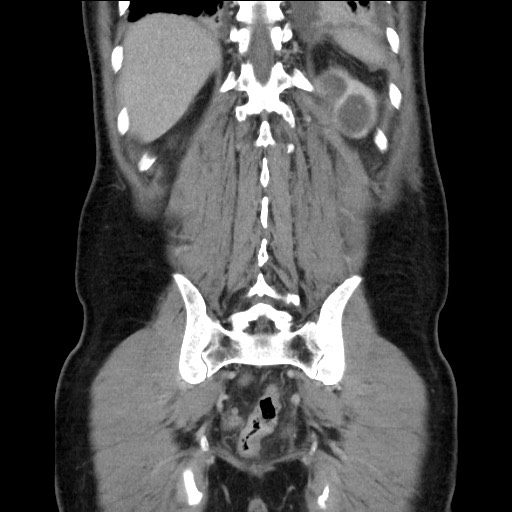 File:Chronic ureteropelvic junction obstruction (Radiopaedia 78365-90996 B 81).jpg