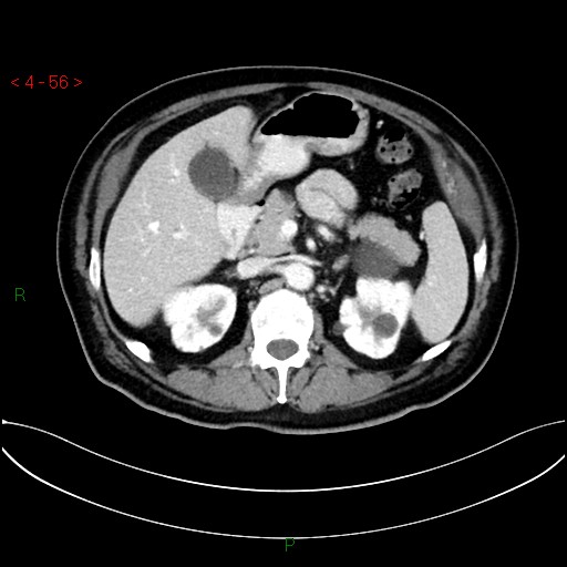 File:Circumaortic left renal vein and doubled left renal arteries (Radiopaedia 52268-58158 B 16).jpg