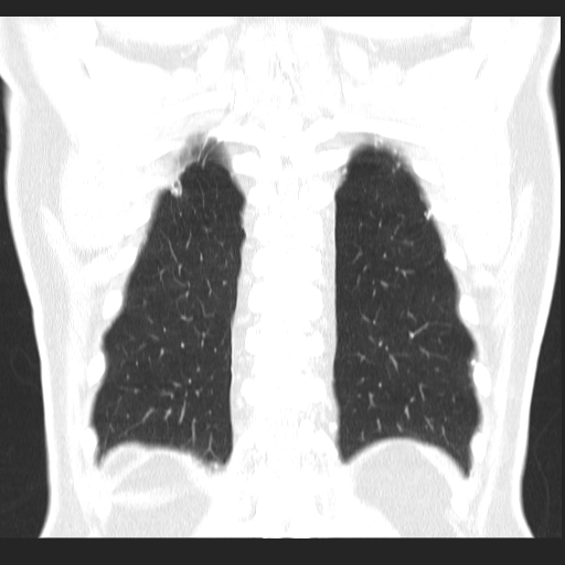 File:Classic complicated silicosis (Radiopaedia 49720-54961 Coronal lung window 53).jpg