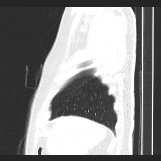 Classic complicated silicosis (Radiopaedia 49720-54961 Sagittal lung window 56).jpg