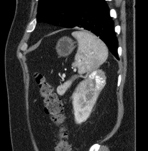 File:Clear cell renal cell carcinoma (Radiopaedia 61449-69393 D 10).jpg