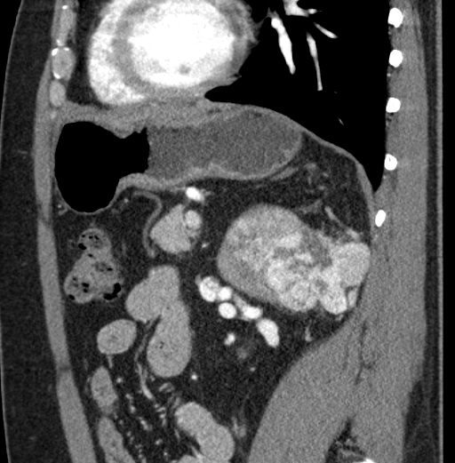 File:Clear cell renal cell carcinoma (Radiopaedia 61449-69393 D 35).jpg
