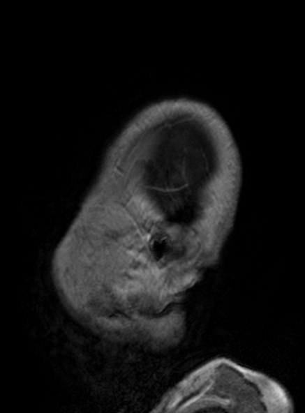 Clival meningioma (Radiopaedia 53278-59248 Sagittal T1 C+ 129).jpg