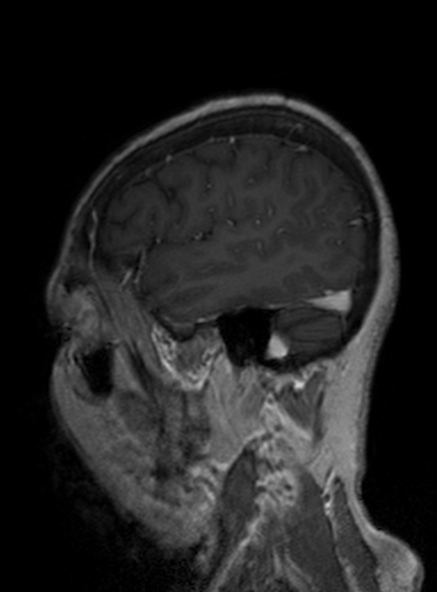 Clival meningioma (Radiopaedia 53278-59248 Sagittal T1 C+ 167).jpg