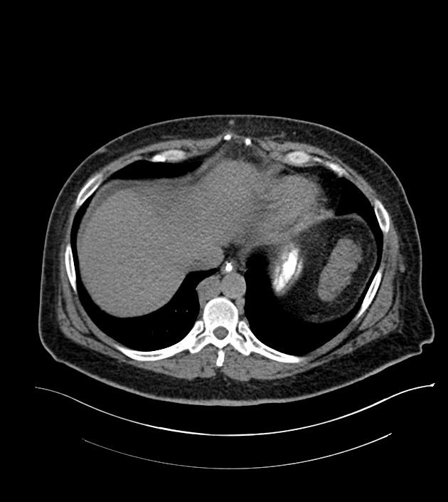 Closed-loop small bowel obstruction-internal hernia (Radiopaedia 78439-91096 Axial non-contrast 20).jpg
