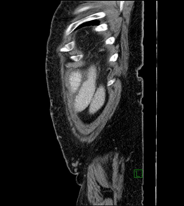 Closed-loop small bowel obstruction-internal hernia (Radiopaedia 78439-91096 C 21).jpg