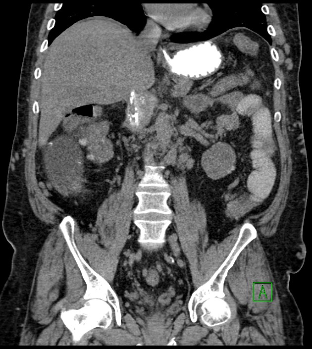 Closed-loop small bowel obstruction-internal hernia (Radiopaedia 78439-91096 Coronal non-contrast 58).jpg