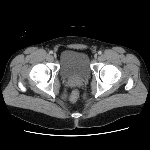 File:Closed-loop small bowel obstruction (Radiopaedia 73713-84509 A 163).jpg