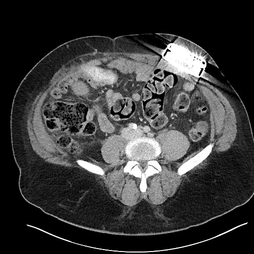 File:Closed loop obstruction - internal hernia into nephrectomy bed (Radiopaedia 59867-67320 A 90).jpg