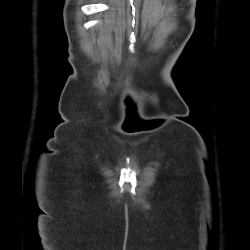 File:Closed loop obstruction due to adhesive band, resulting in small bowel ischemia and resection (Radiopaedia 83835-99023 C 117).jpg