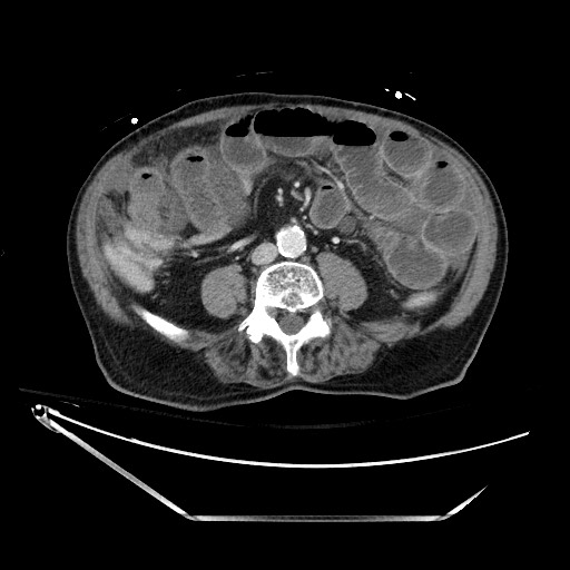 File:Closed loop obstruction due to adhesive band, resulting in small bowel ischemia and resection (Radiopaedia 83835-99023 D 90).jpg