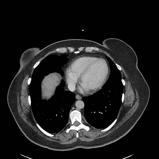 File:Closed loop small bowel obstruction (Radiopaedia 50344).jpg
