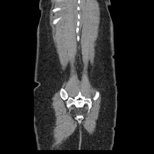 File:Closed loop small bowel obstruction (Radiopaedia 65403-74451 B 96).jpg