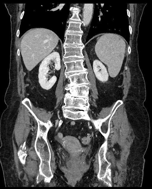 Closed loop small bowel obstruction - adhesions (Radiopaedia 59269-66611 B 83).jpg