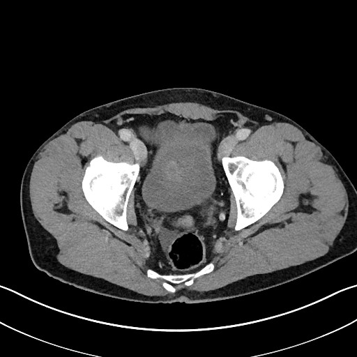 Closed loop small bowel obstruction - internal hernia (Radiopaedia 57806-64778 B 115).jpg