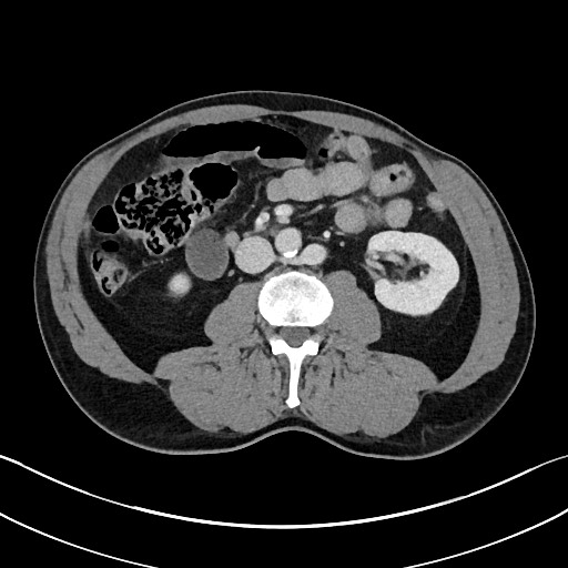 Closed loop small bowel obstruction - internal hernia (Radiopaedia 57806-64778 B 60).jpg