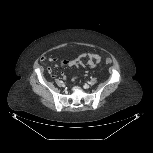File:Closed loop small bowel obstruction - internal hernia (Radiopaedia 65402-74450 A 96).jpg
