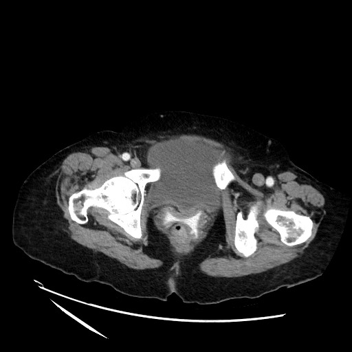 File:Closed loop small bowel obstruction due to adhesive band, with intramural hemorrhage and ischemia (Radiopaedia 83831-99017 Axial 130).jpg
