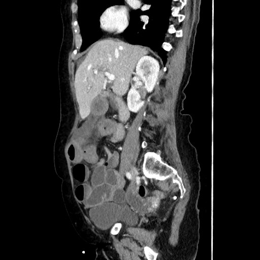 Closed loop small bowel obstruction due to adhesive band, with intramural hemorrhage and ischemia (Radiopaedia 83831-99017 D 84).jpg