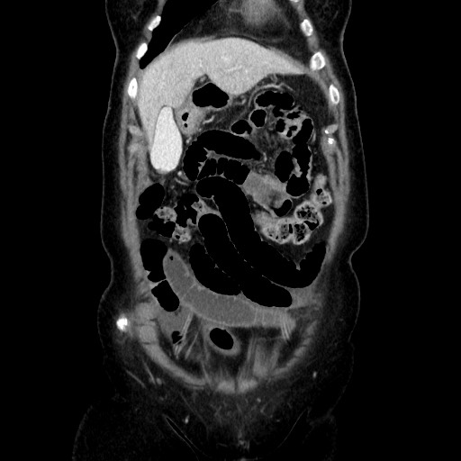 Closed loop small bowel obstruction due to adhesive bands - early and late images (Radiopaedia 83830-99015 B 34).jpg