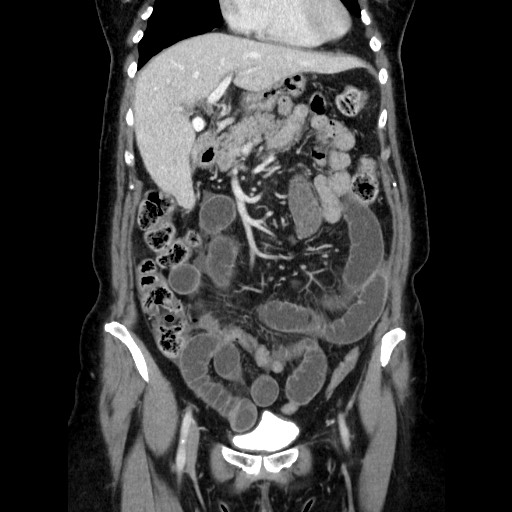 Closed loop small bowel obstruction due to adhesive bands - early and late images (Radiopaedia 83830-99015 B 46).jpg