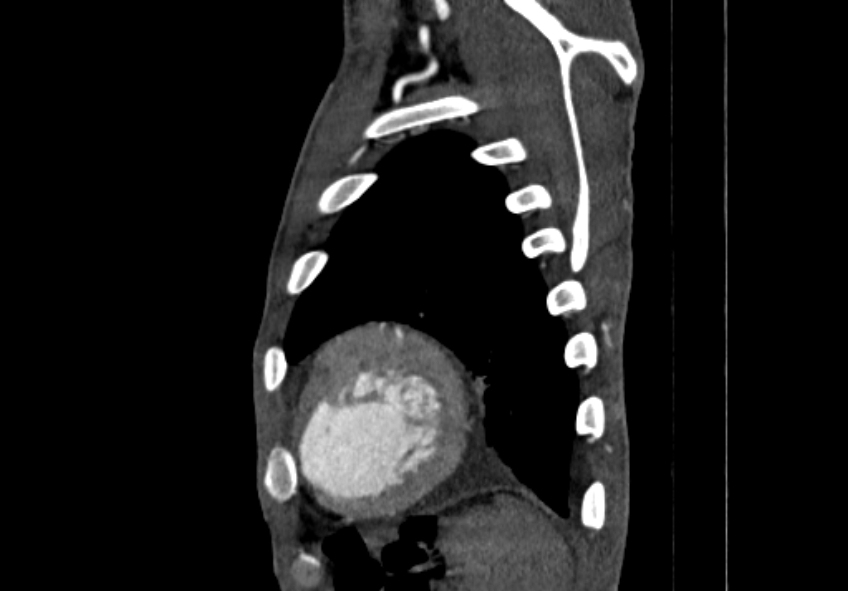 Coarctation of aorta with aortic valve stenosis (Radiopaedia 70463-80574 B 213).jpg