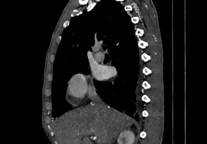 Coarctation of aorta with aortic valve stenosis (Radiopaedia 70463-80574 B 3).jpg