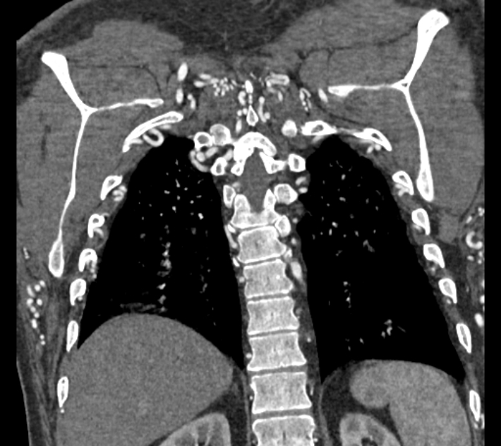 Coarctation of the aorta (Radiopaedia 53752-59822 B 65).jpg