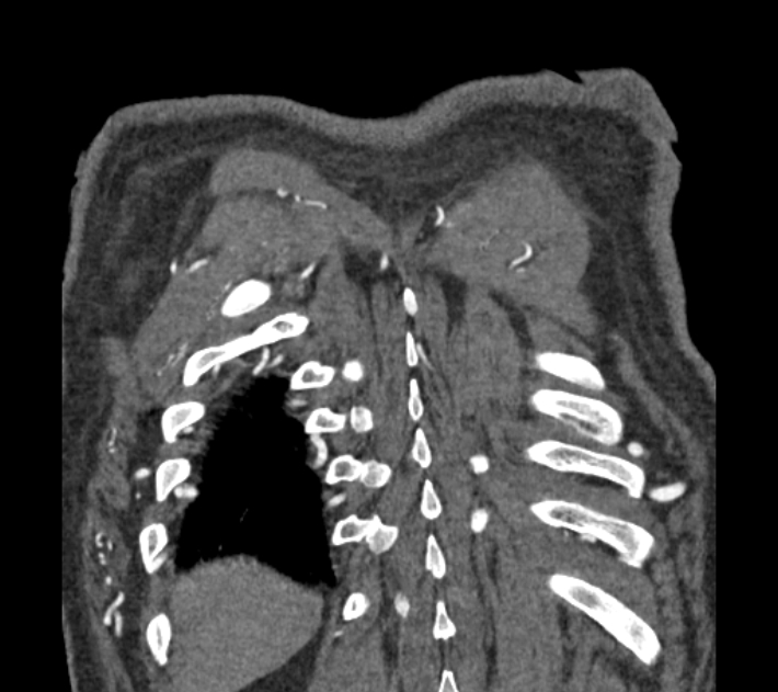 Coarctation of the aorta (Radiopaedia 53752-59822 B 77).jpg