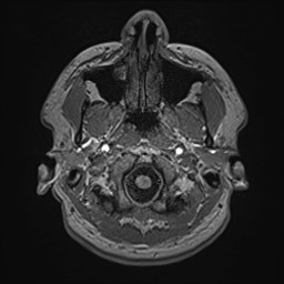 File:Cochlear incomplete partition type III associated with hypothalamic hamartoma (Radiopaedia 88756-105498 Axial T1 31).jpg