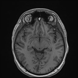 File:Cochlear incomplete partition type III associated with hypothalamic hamartoma (Radiopaedia 88756-105498 Axial T1 94).jpg
