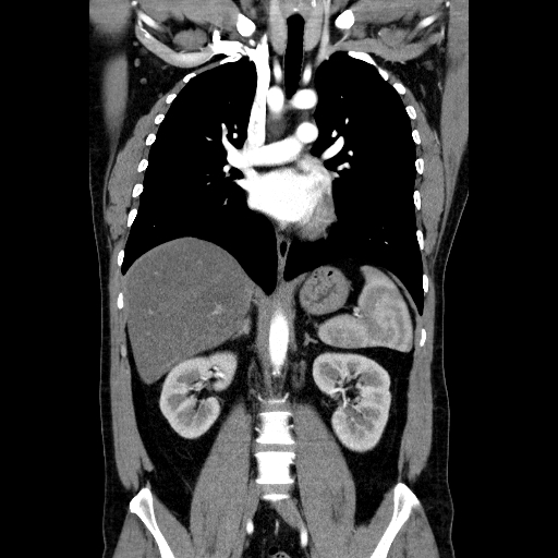 File:Codominant double aortic arch (Radiopaedia 56012-62637 B 26).jpg