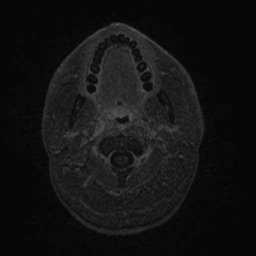 File:Colloid cyst (Radiopaedia 44510-48181 Axial T1 C+ 2).png