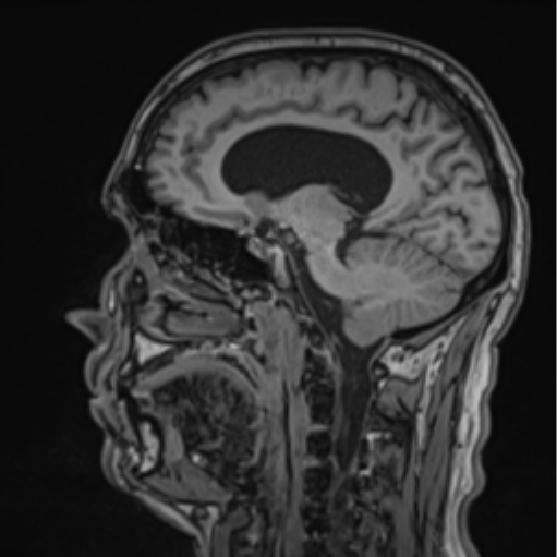 File:Colloid cyst of the third ventricle (Radiopaedia 86571-102662 Sagittal T1 34).png