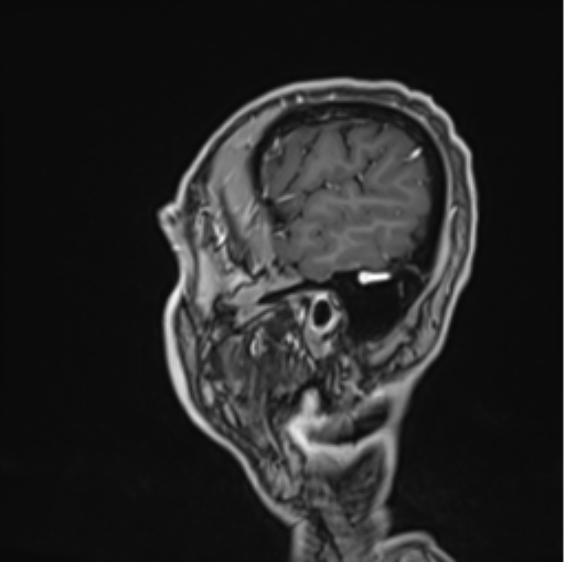 File:Colloid cyst of the third ventricle (Radiopaedia 86571-102662 Sagittal T1 C+ 10).png