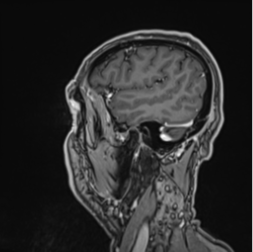 File:Colloid cyst of the third ventricle (Radiopaedia 86571-102662 Sagittal T1 C+ 64).png
