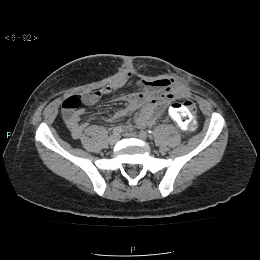 Colo-cutaneous fistula (Radiopaedia 40531-43129 A 38).jpg