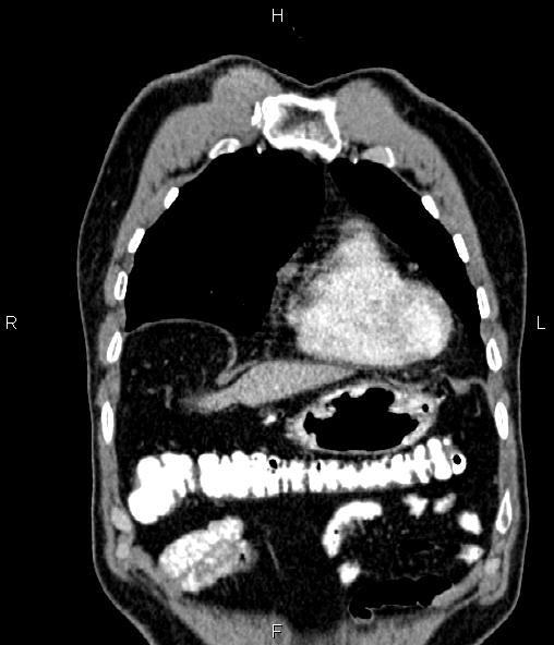 Colon adenocarcinoma (Radiopaedia 83266-97671 C 13).jpg