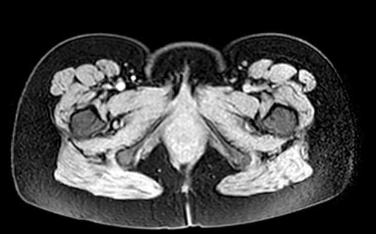 Colon adenocarcinoma with Krukenberg tumors, advanced pregnancy (Radiopaedia 67279-76645 A 3).jpg
