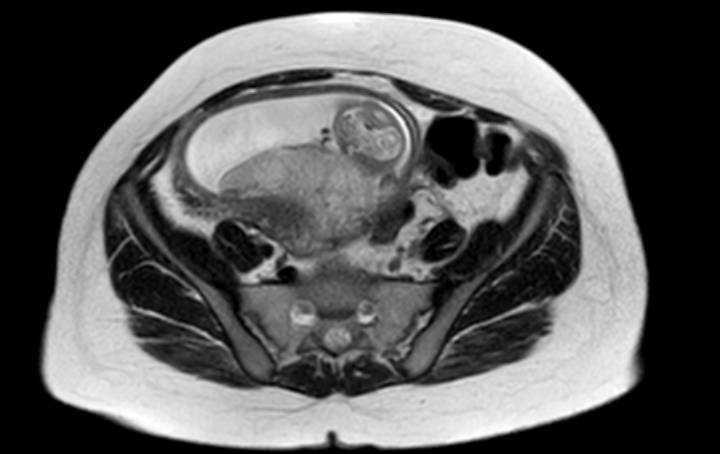 Colon adenocarcinoma with Krukenberg tumors, advanced pregnancy (Radiopaedia 67279-76645 Axial T2 23).jpg