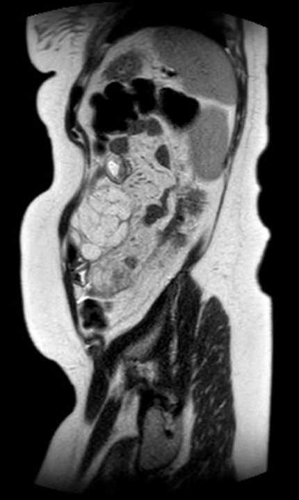 Colon adenocarcinoma with Krukenberg tumors, advanced pregnancy (Radiopaedia 67279-76645 Sagittal T2 12).jpg