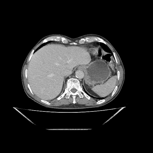 Colon cancer (ultrasound) (Radiopaedia 77249-89300 A 1).jpg