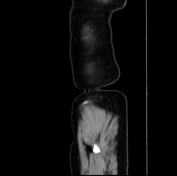 Colon carcinoma with hepatic metastases (Radiopaedia 29477-29961 C 1).jpg