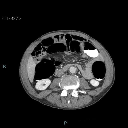 File:Colonic cancer (ultrasound and TC imaging) (Radiopaedia 50346-55713 A 59).jpg
