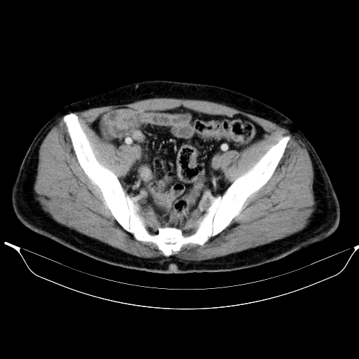 Colonic lipoma with colo-colic intussusception (Radiopaedia 58944-66200 A 55).jpg